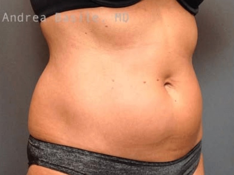 Liposuction Before