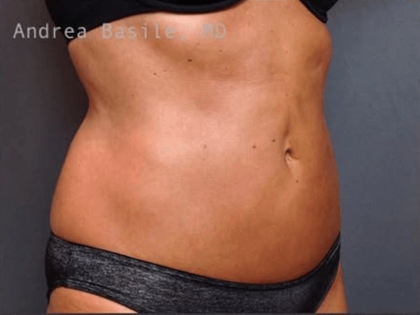 Liposuction After