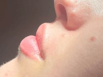 Lip Filler Before