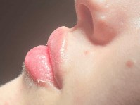 Lip Filler After