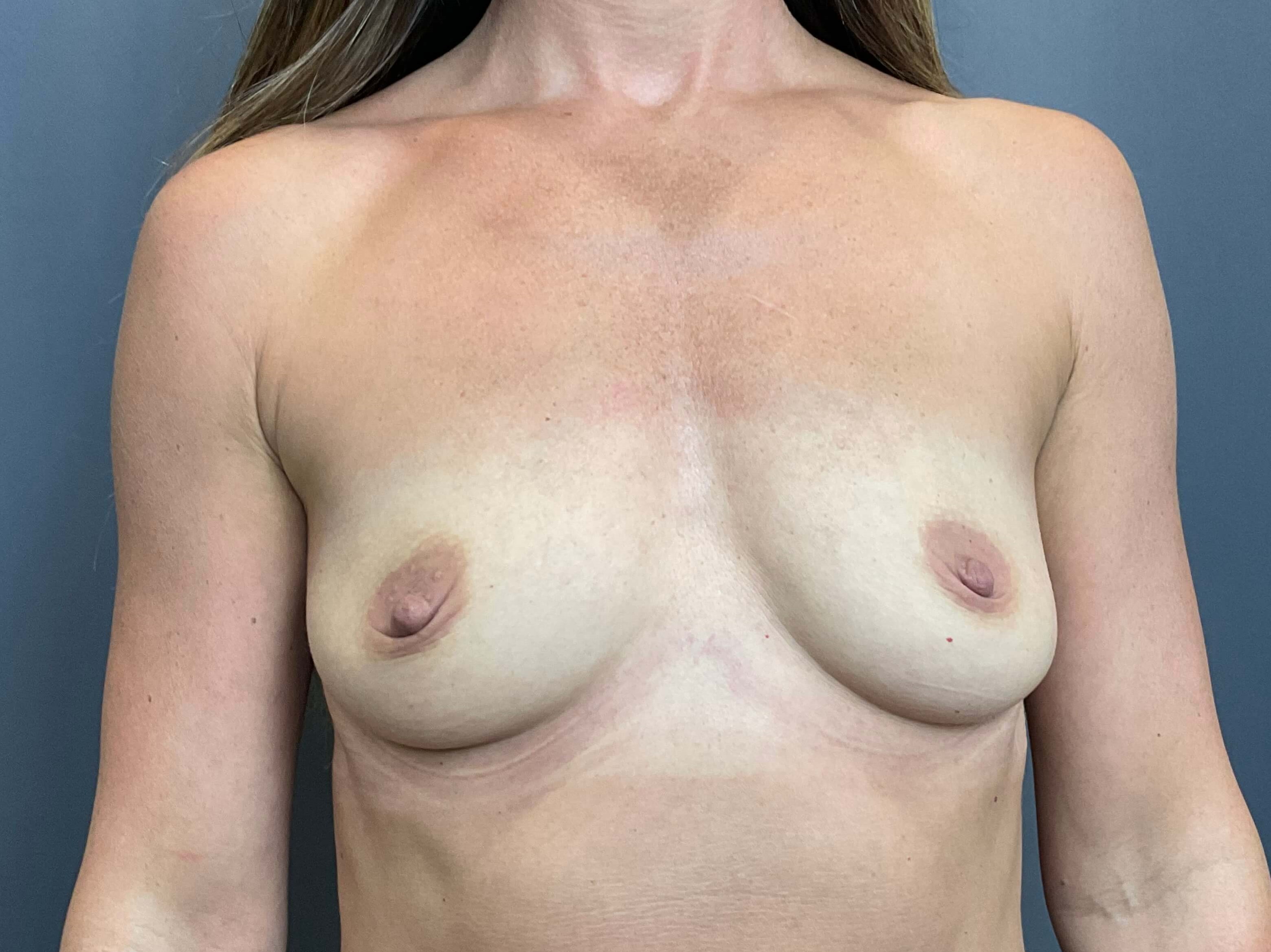 Breast Augmentation Before