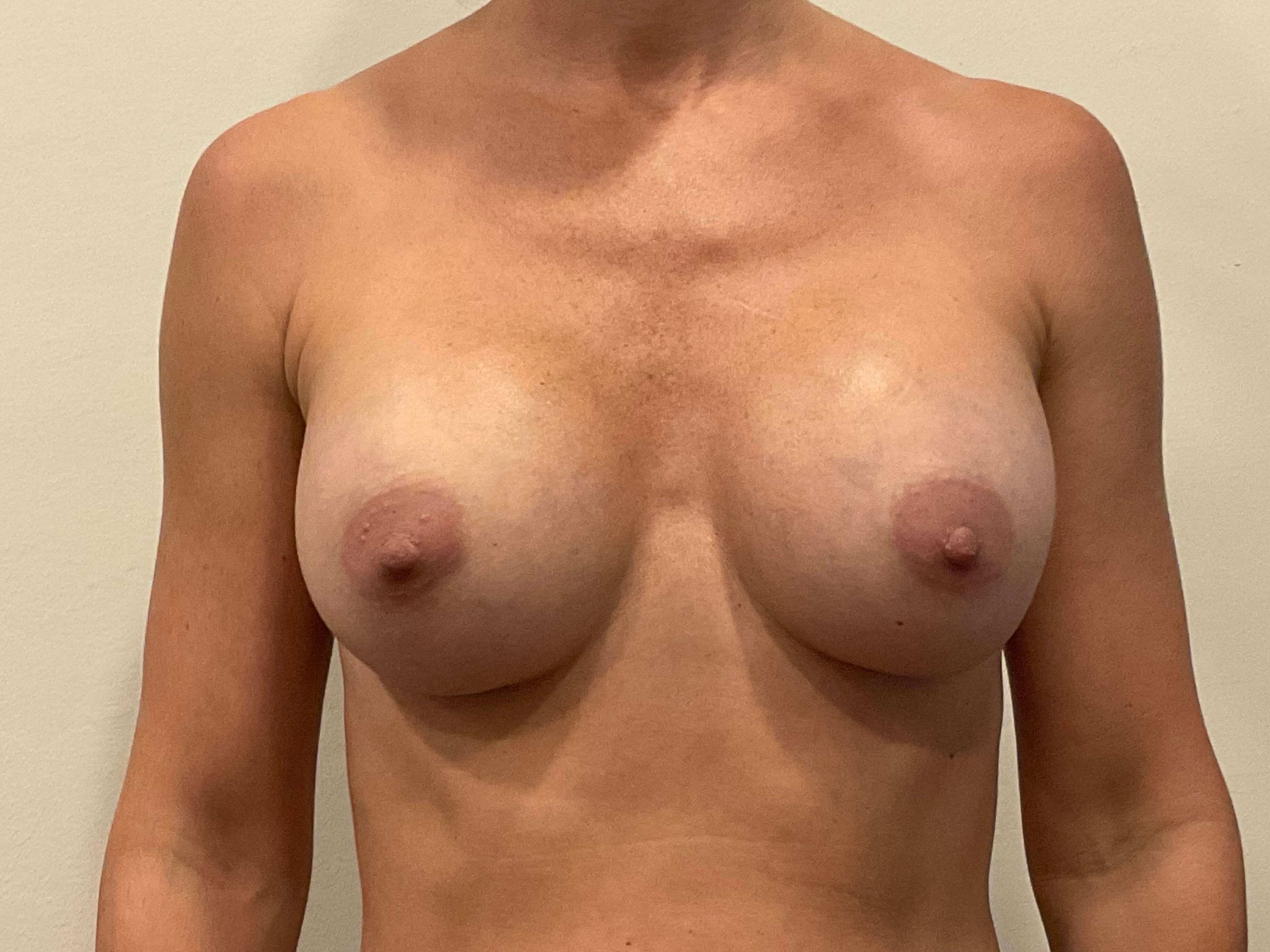 Breast Augmentation After