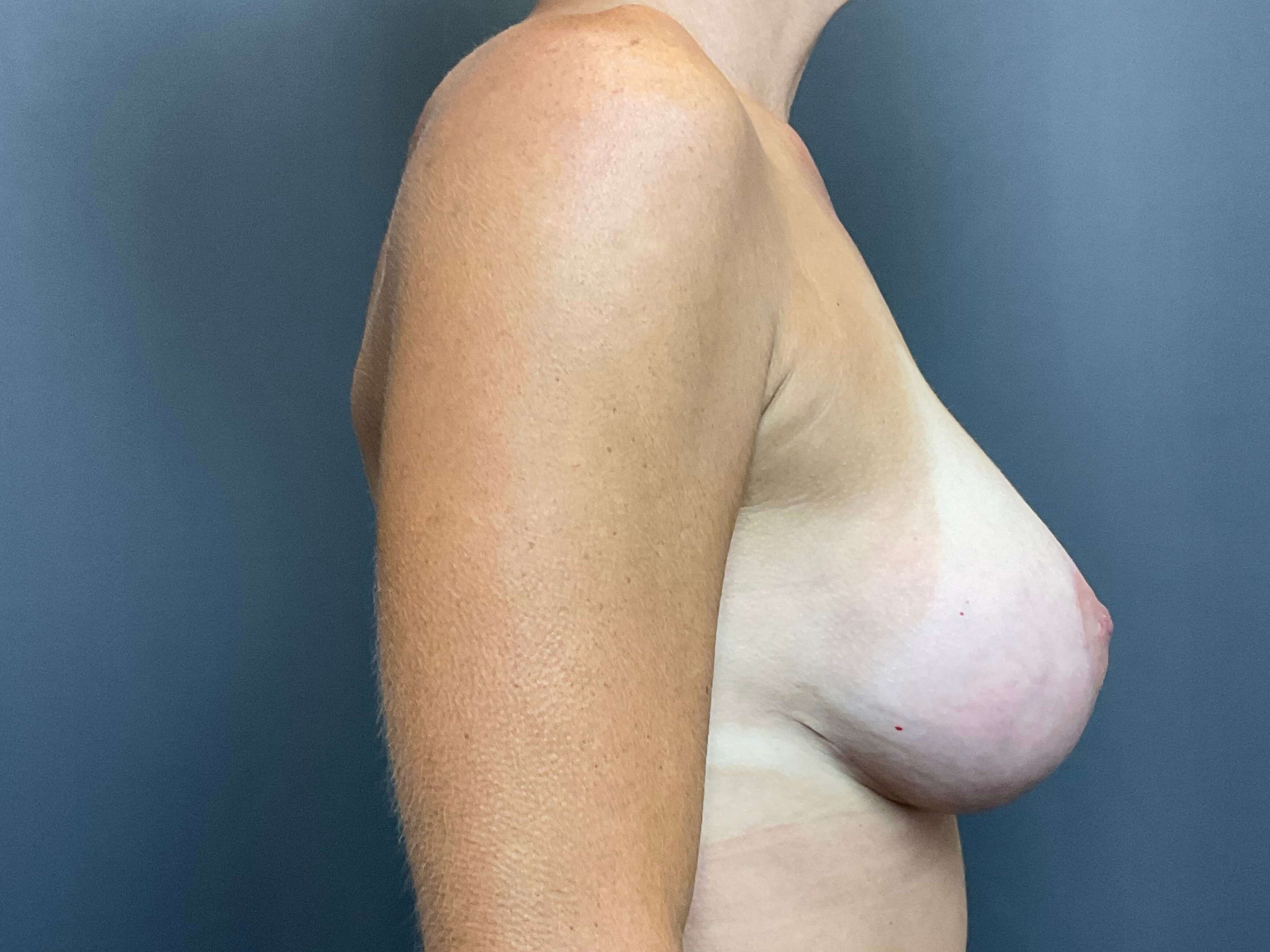 Breast Augmentation with Lift After