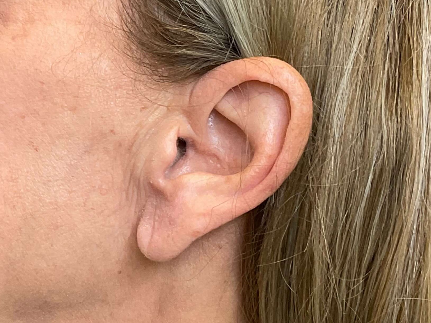 Earlobe Reduction Before