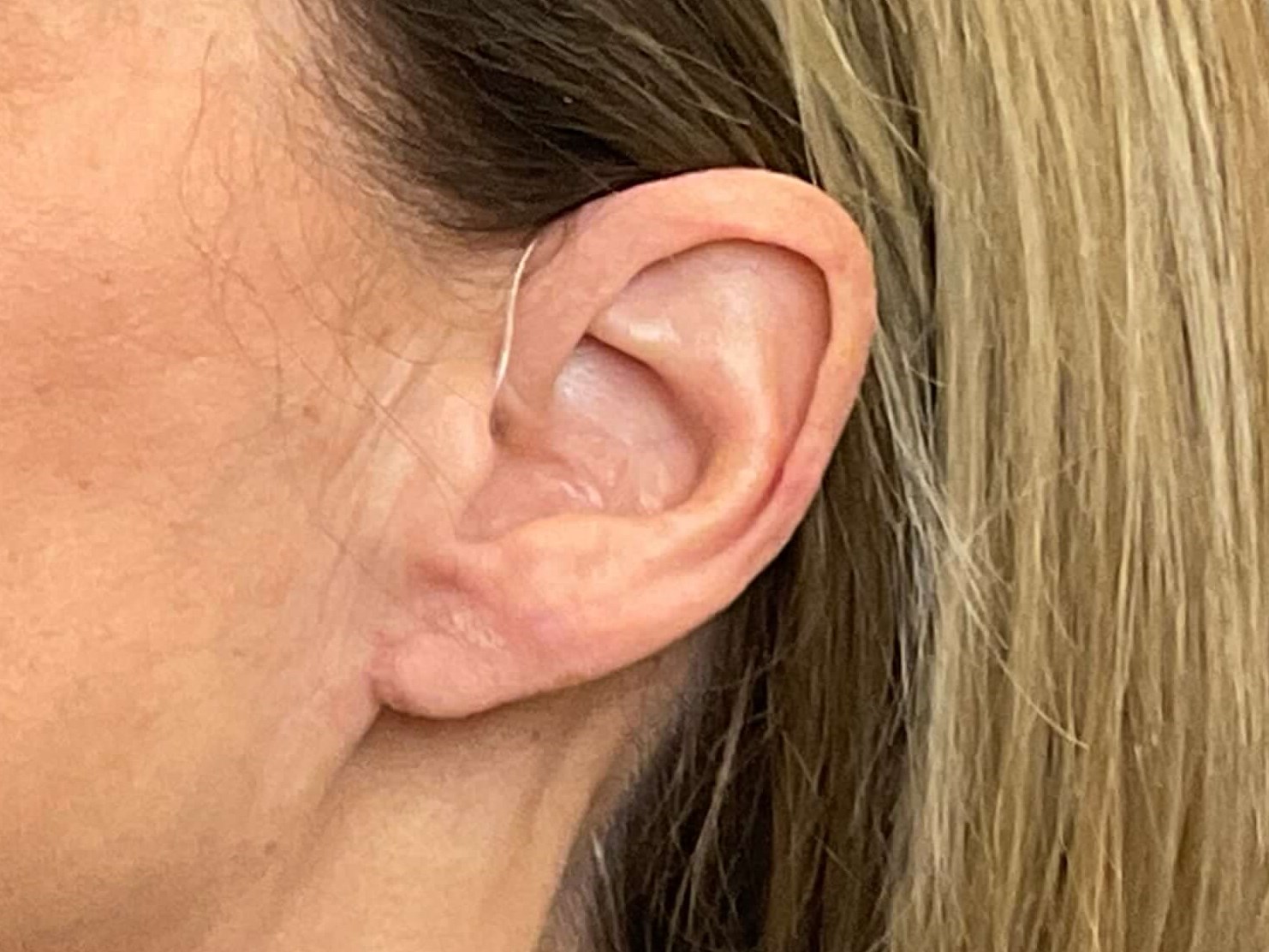 Earlobe Reduction After