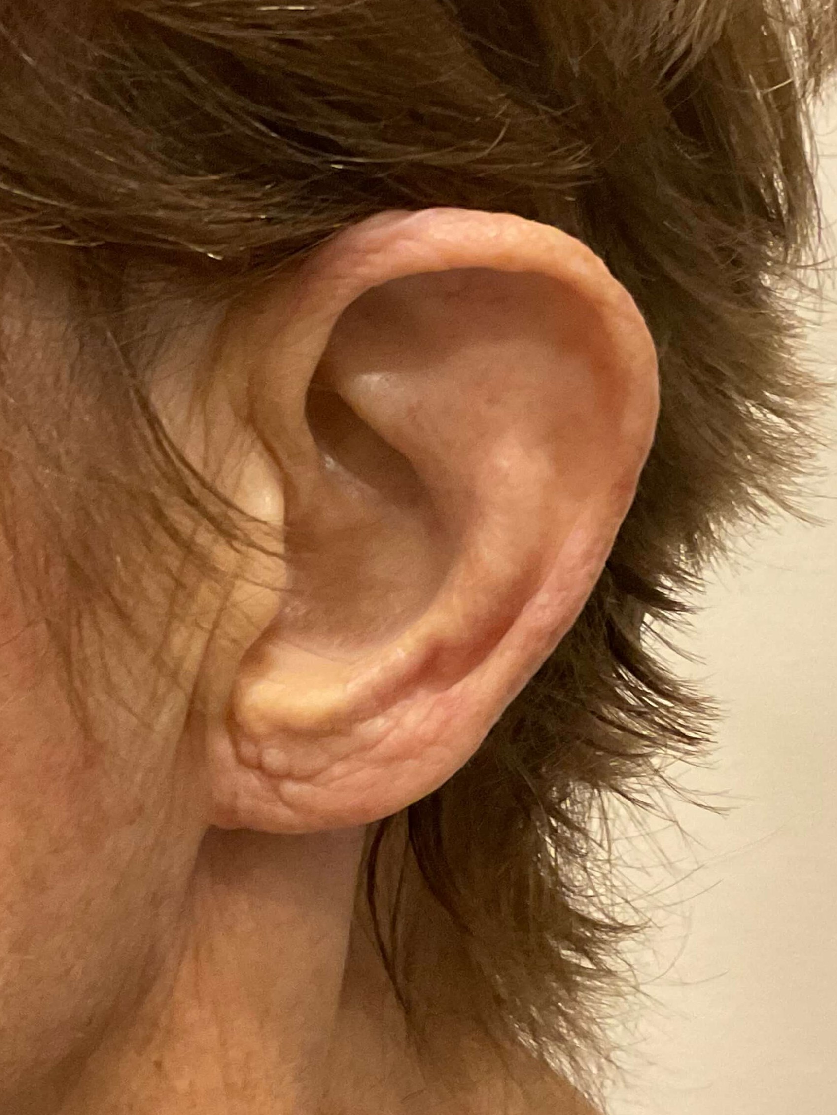 Earlobe Reduction- LEFT After