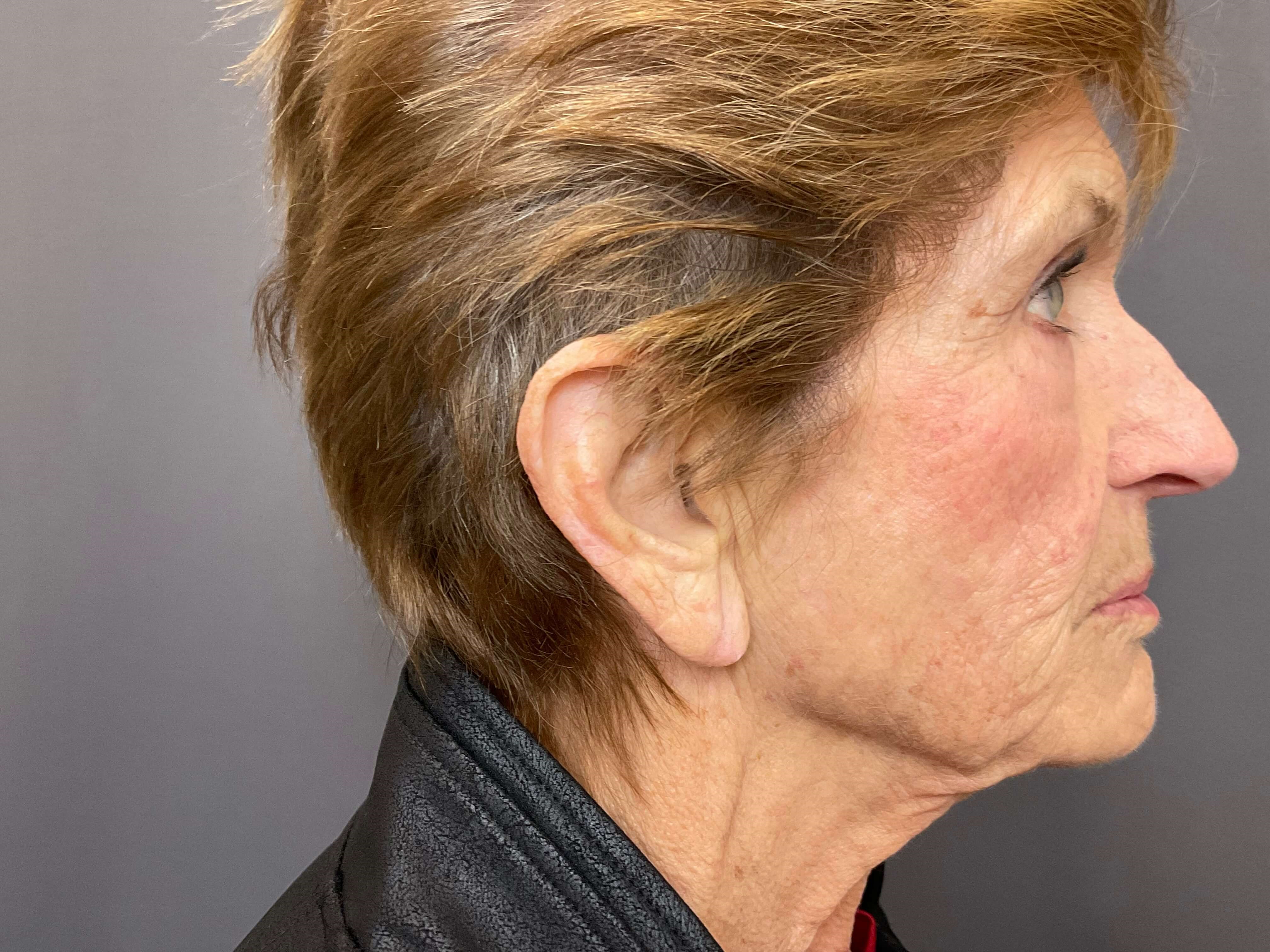 Earlobe Reduction- RIGHT Before