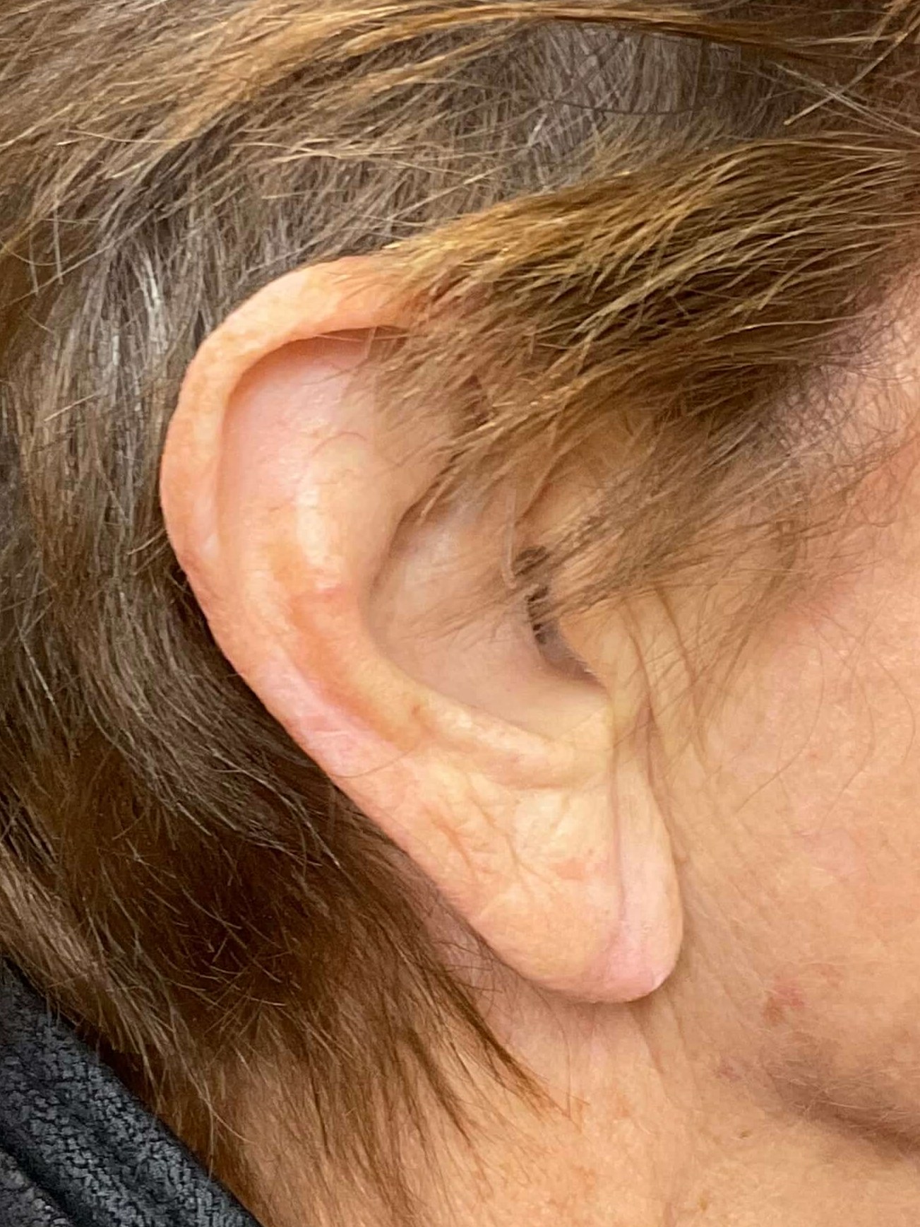 Earlobe Reduction- RIGHT Before