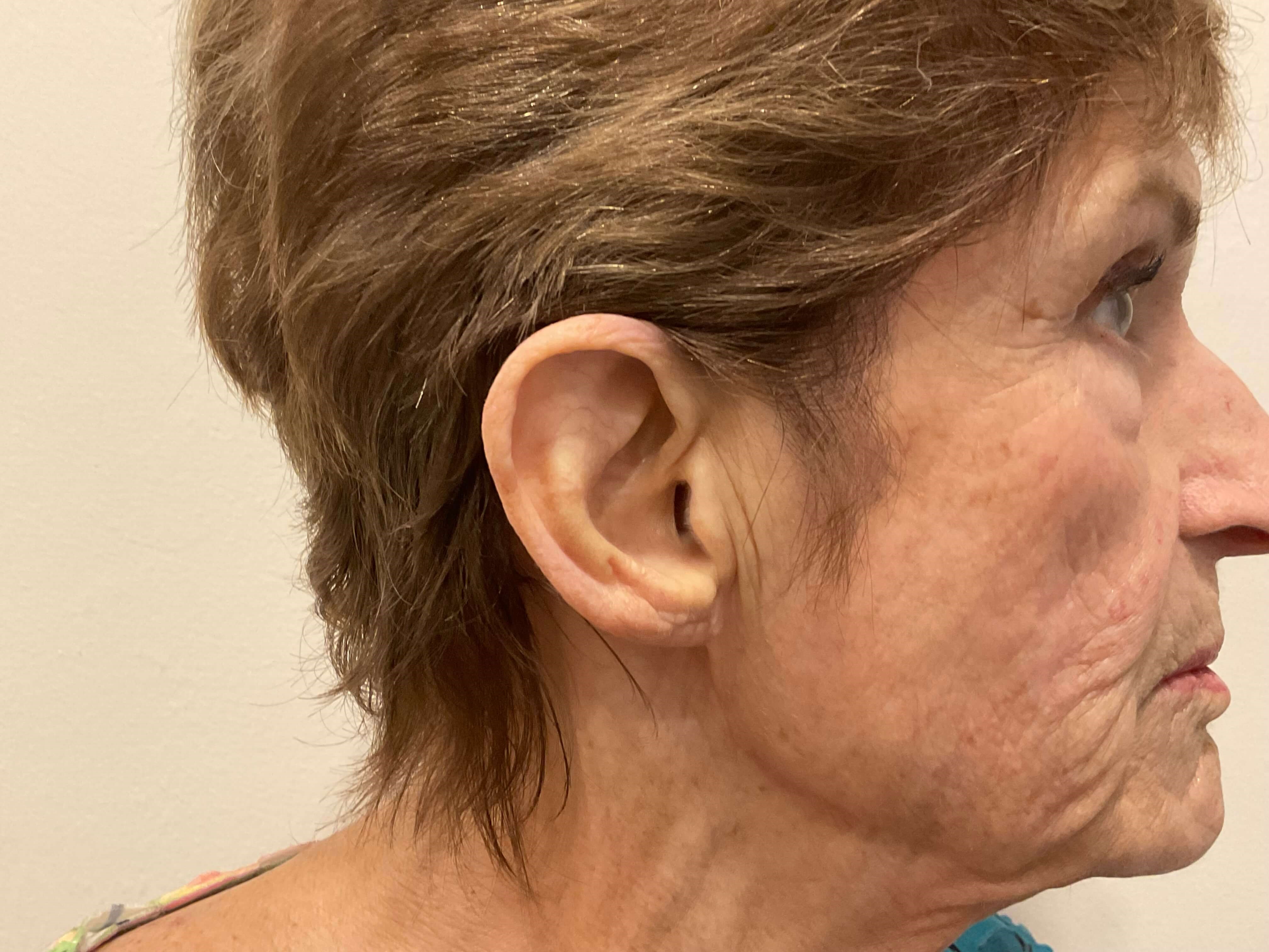 Earlobe Reduction- RIGHT After