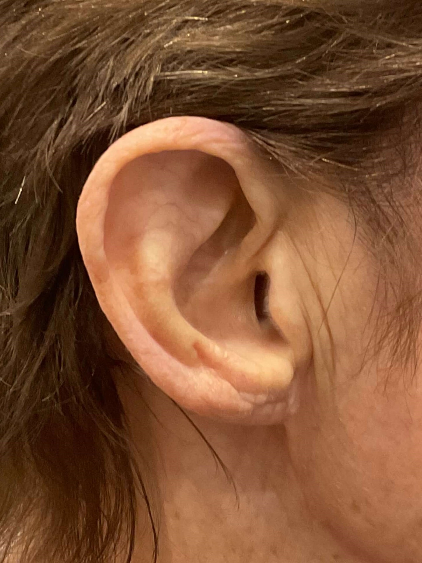 Earlobe Reduction- RIGHT After