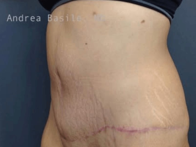 Extended Abdominoplasty After