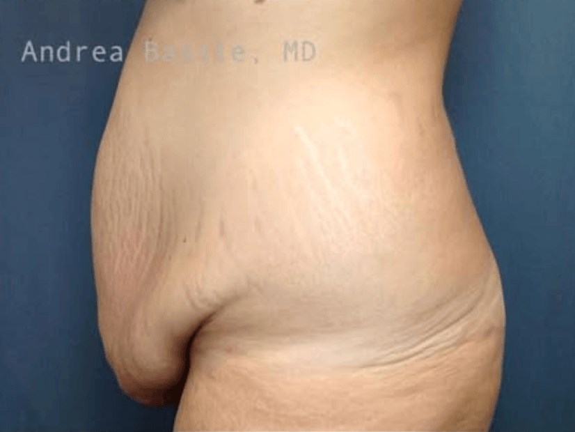 Extended Abdominoplasty Before