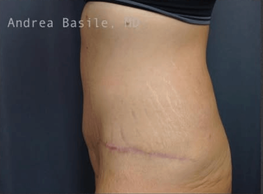 Extended Abdominoplasty After