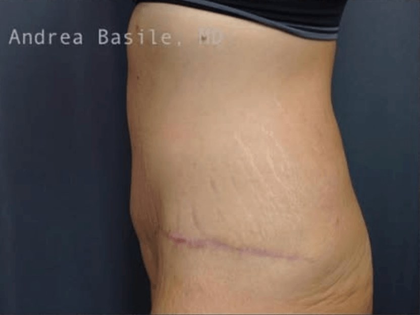 Extended Abdominoplasty After