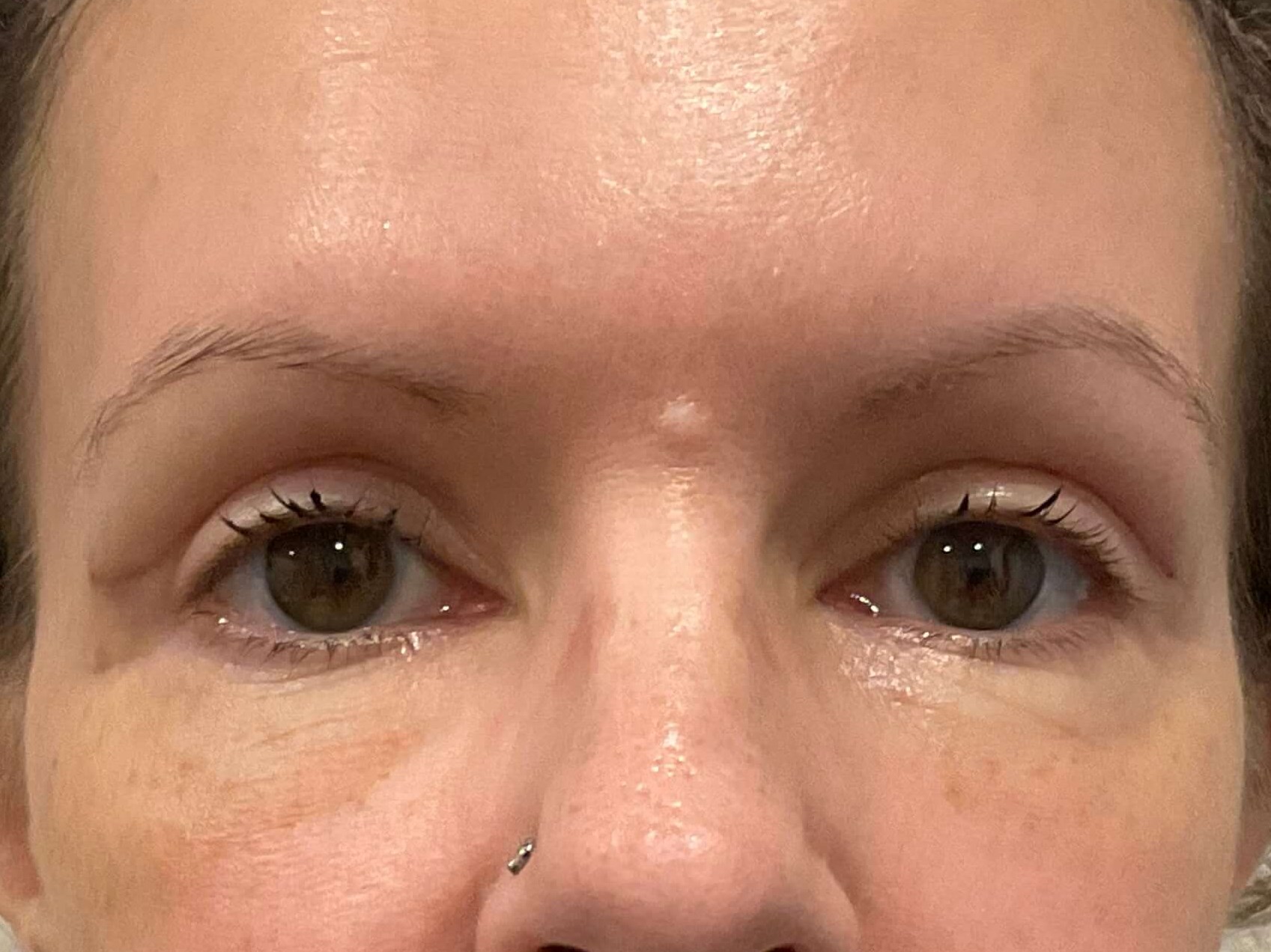 Upper Blepharoplasty After