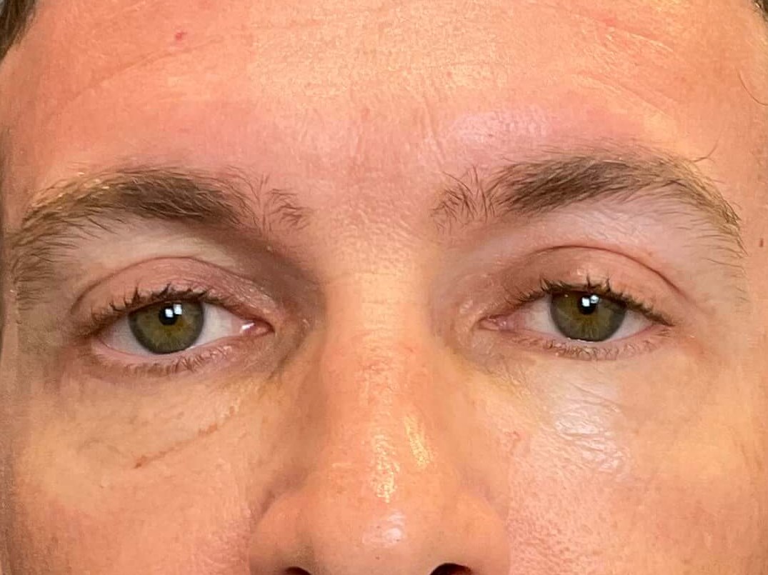 Upper & Lower Blepharoplasty After