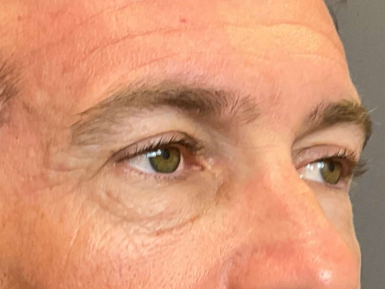 Upper & Lower Blepharoplasty Before