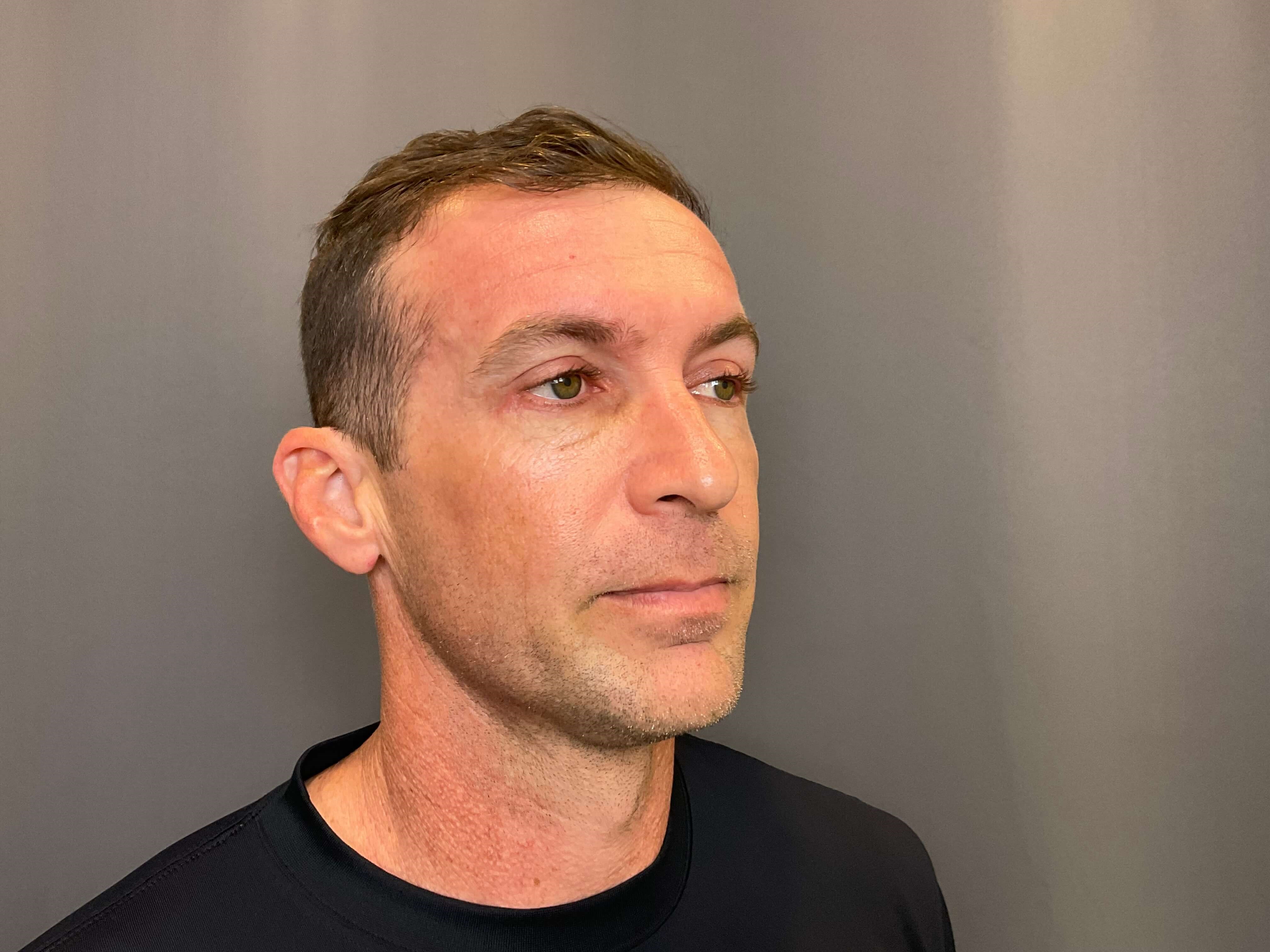 Upper & Lower Blepharoplasty After