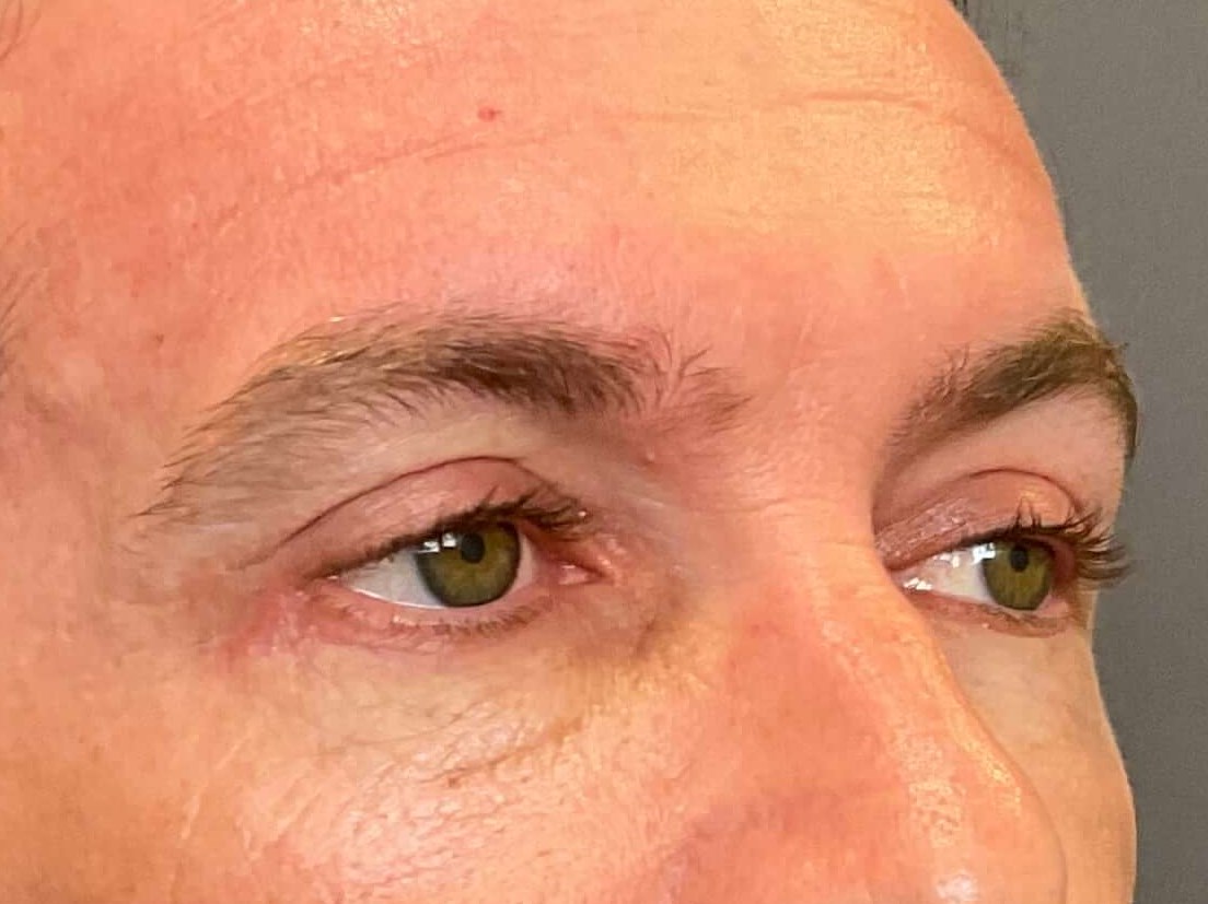 Upper & Lower Blepharoplasty After