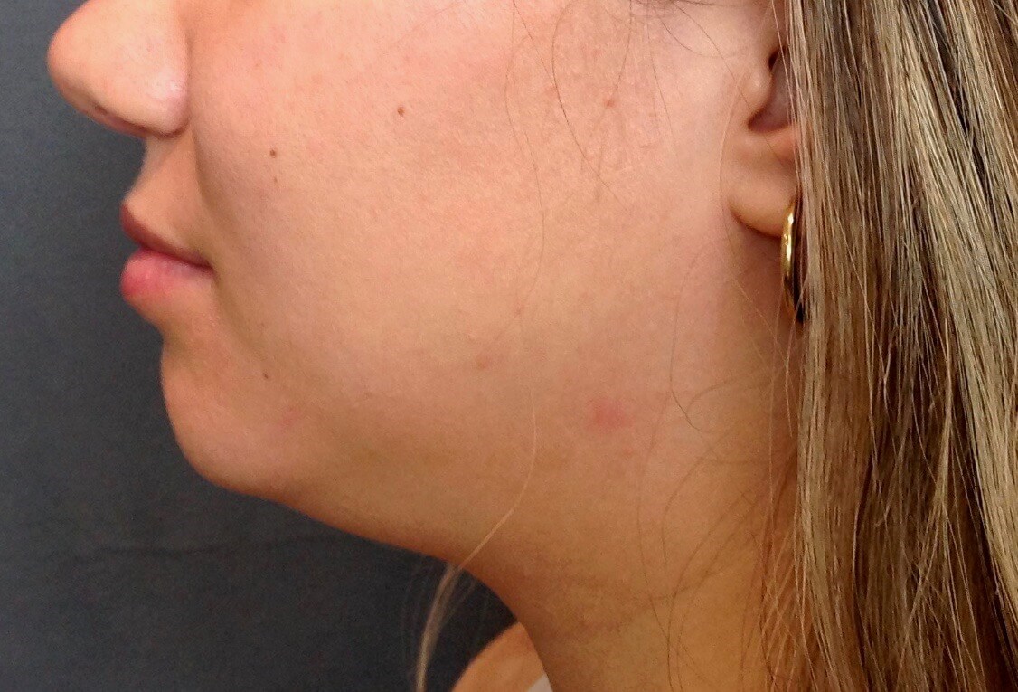 Submental Liposuction Before