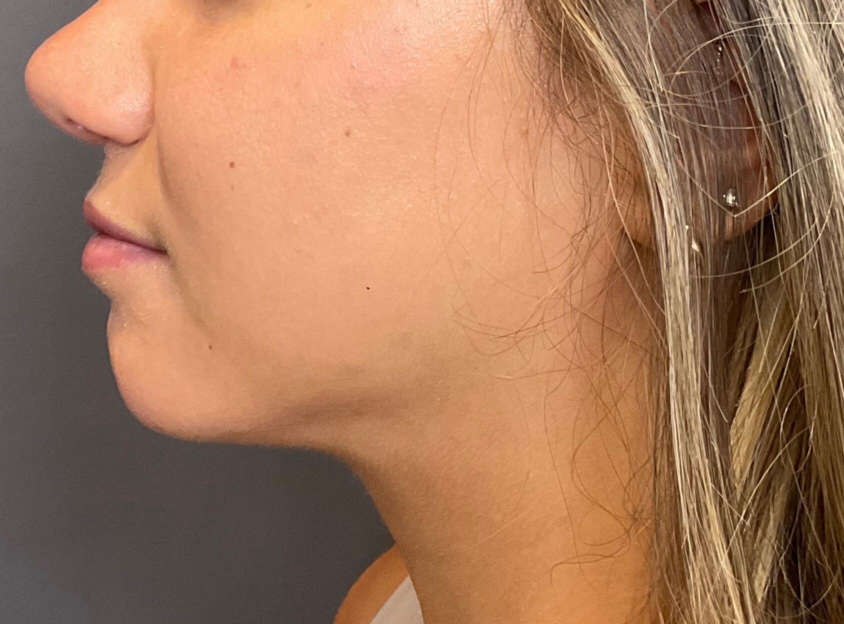 Submental Liposuction After