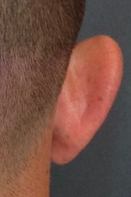 Otoplasty Before