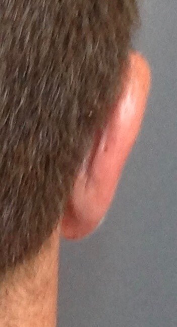 Otoplasty After
