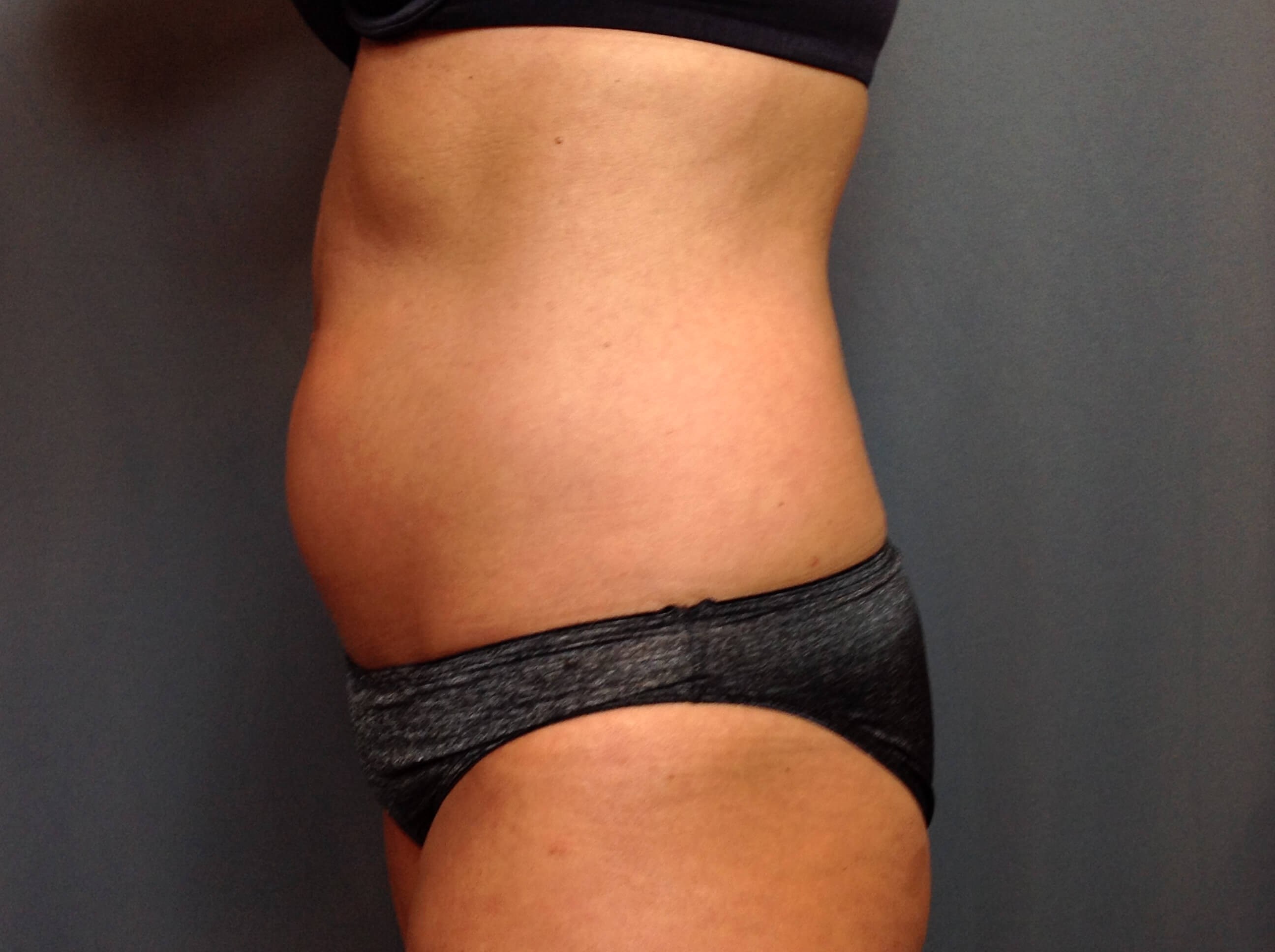 Liposuction Before