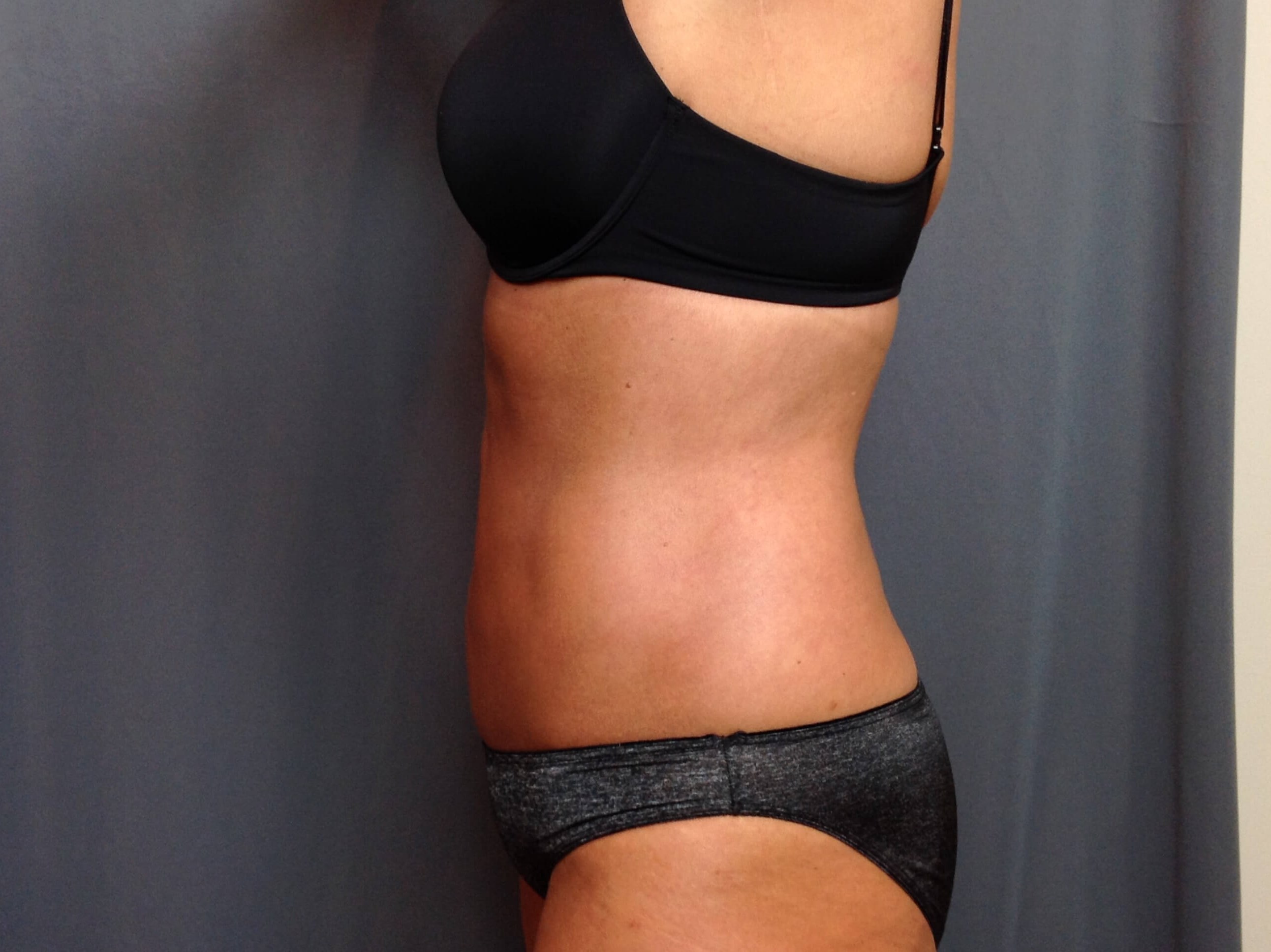Liposuction After