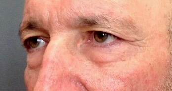 Upper and Lower Blepharoplasty Before