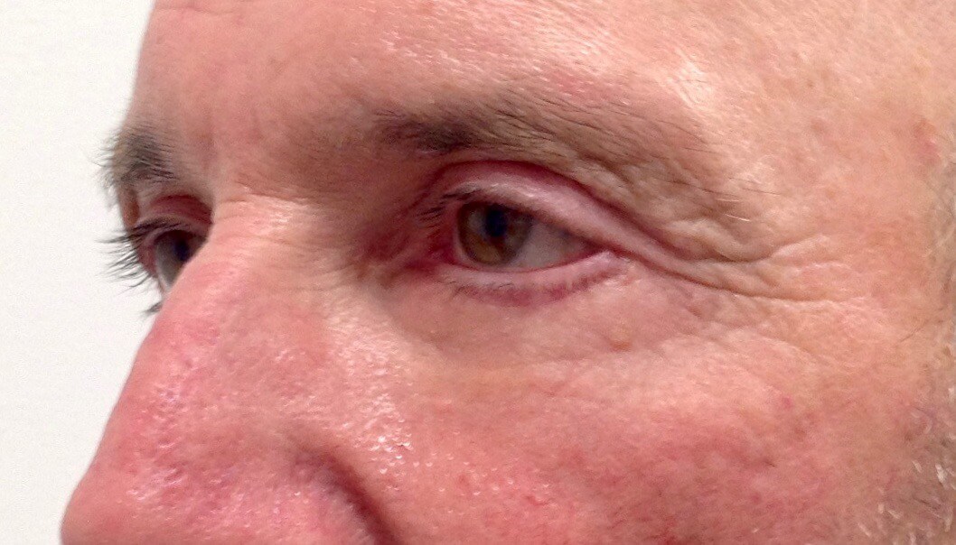 Upper and Lower Blepharoplasty After