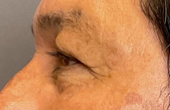 Upper and Lower Blepharoplasty Before