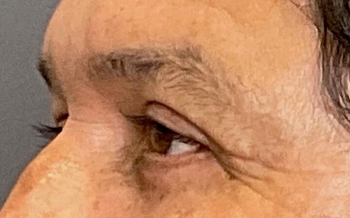 Upper and Lower Blepharoplasty After