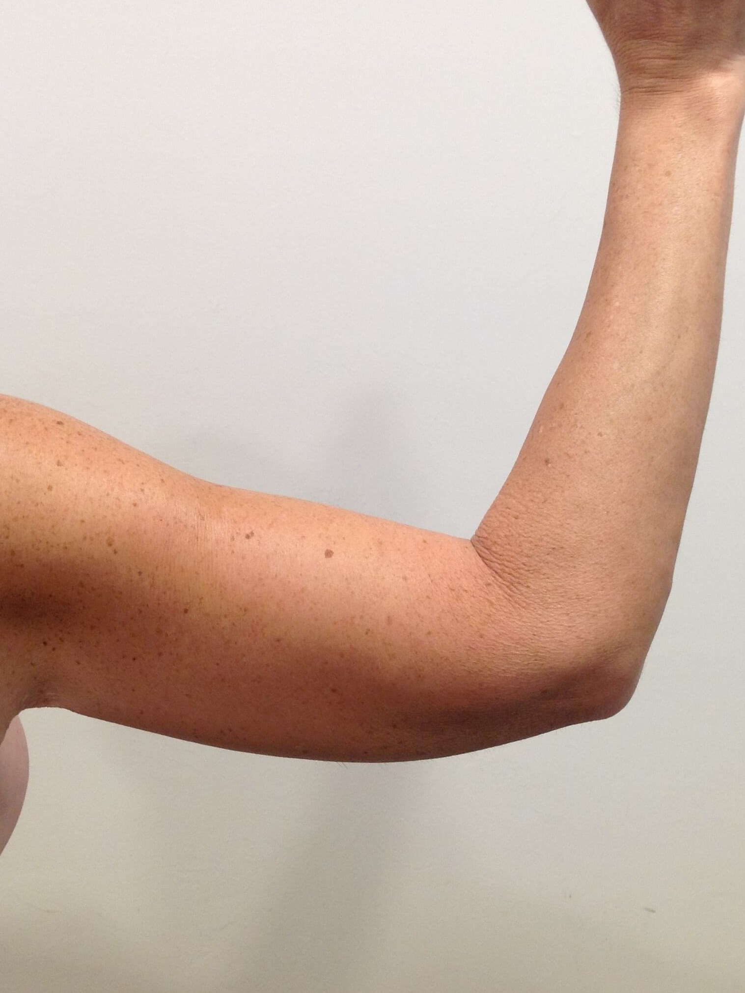 Brachioplasty After