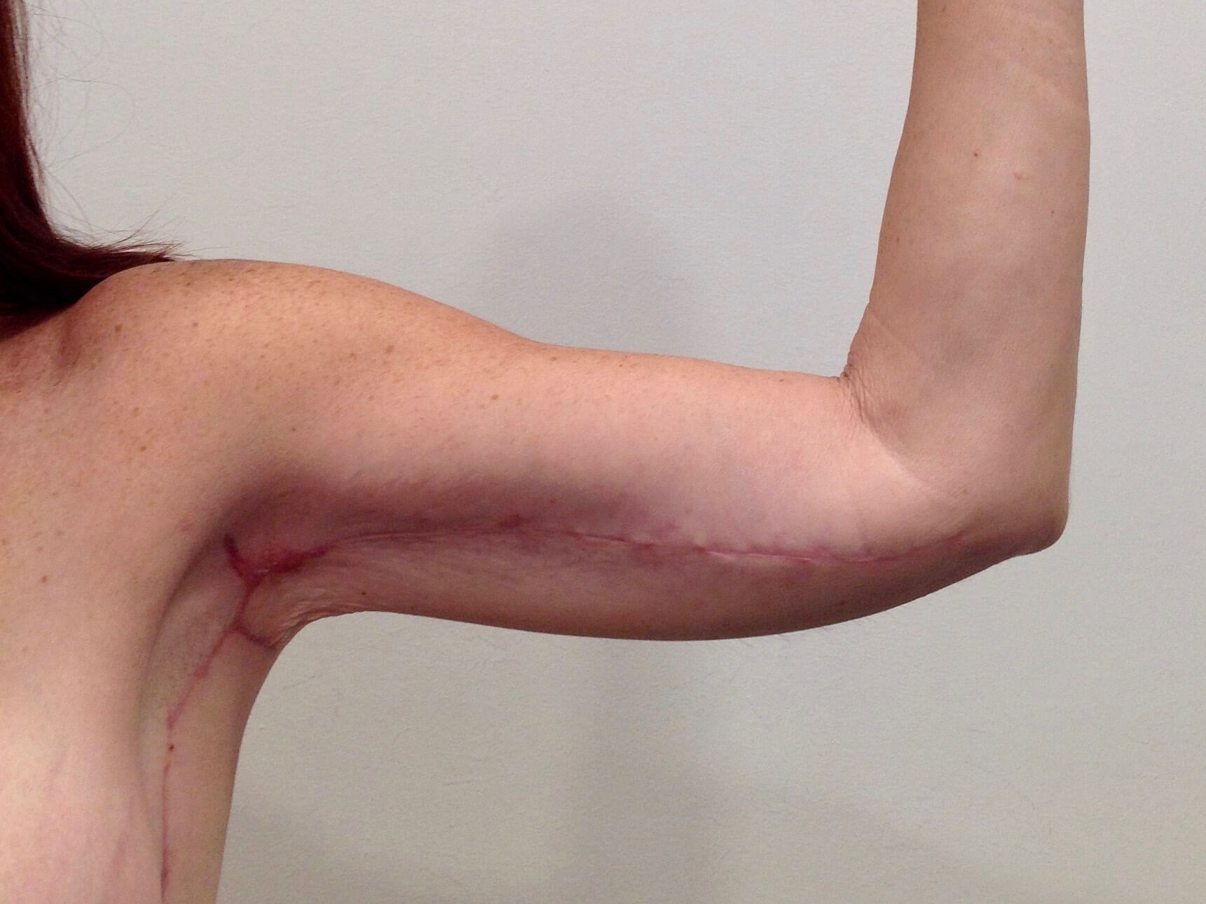 Brachioplasty After