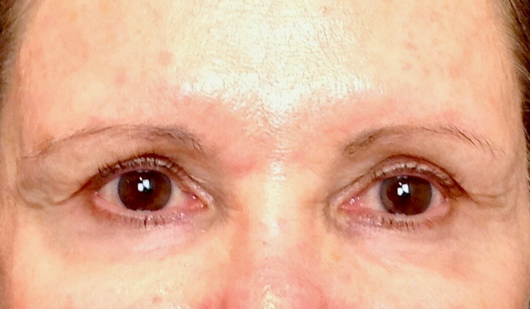 Brow Lift Before