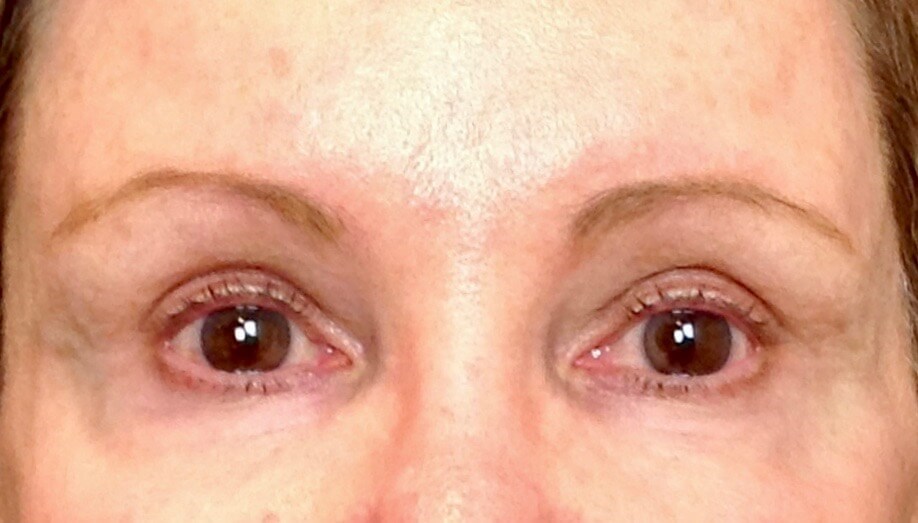 Brow Lift After