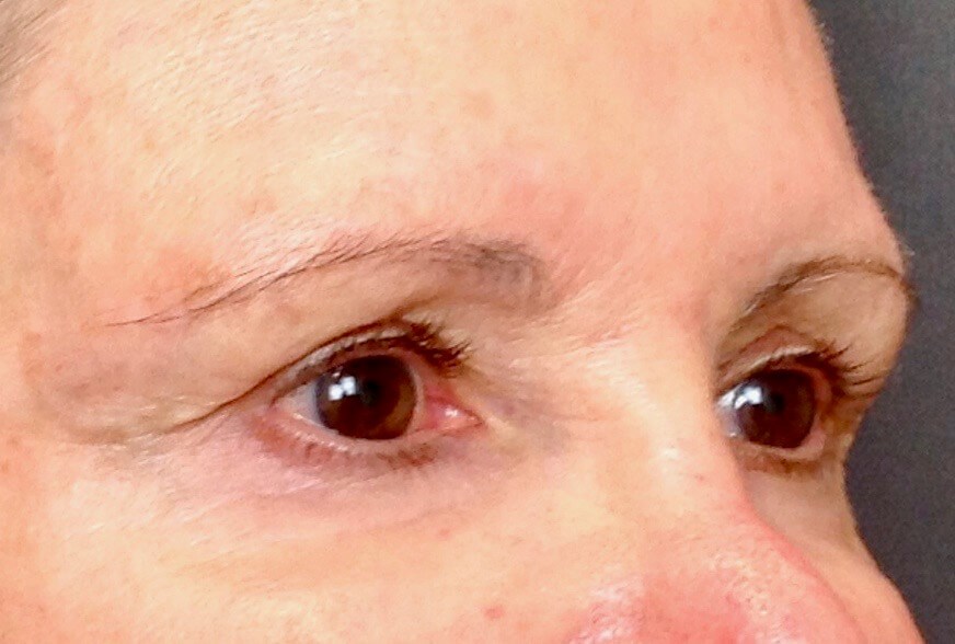Brow Lift Before