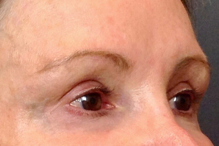 Brow Lift After