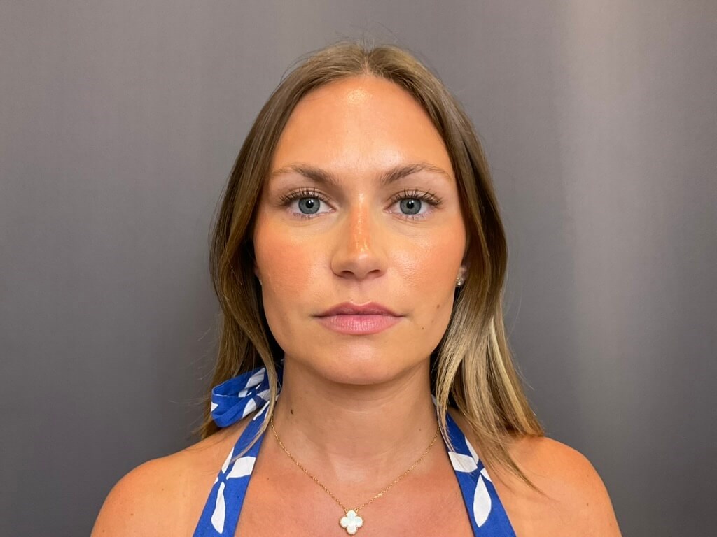 Lip Filler Before