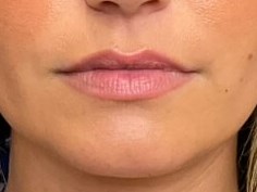 Lip Filler Before