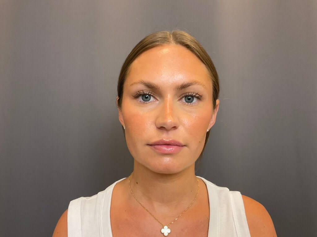 Lip Filler After
