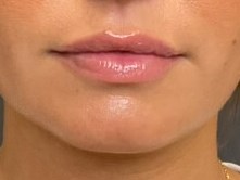 Lip Filler After