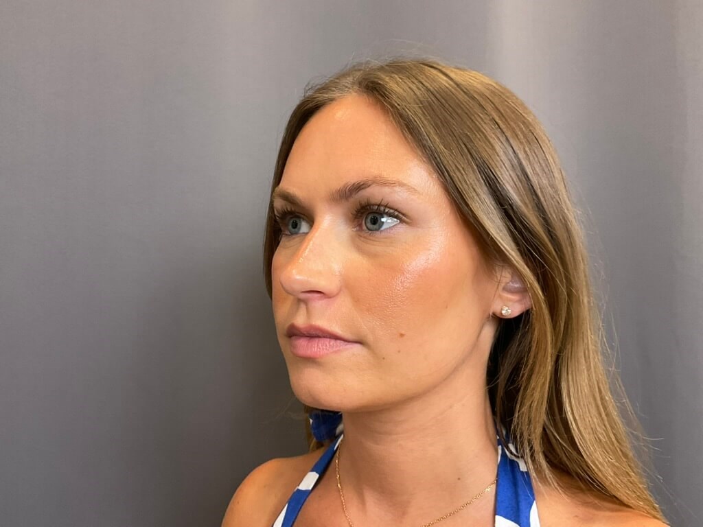 Lip Filler Before