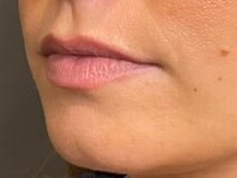 Lip Filler Before