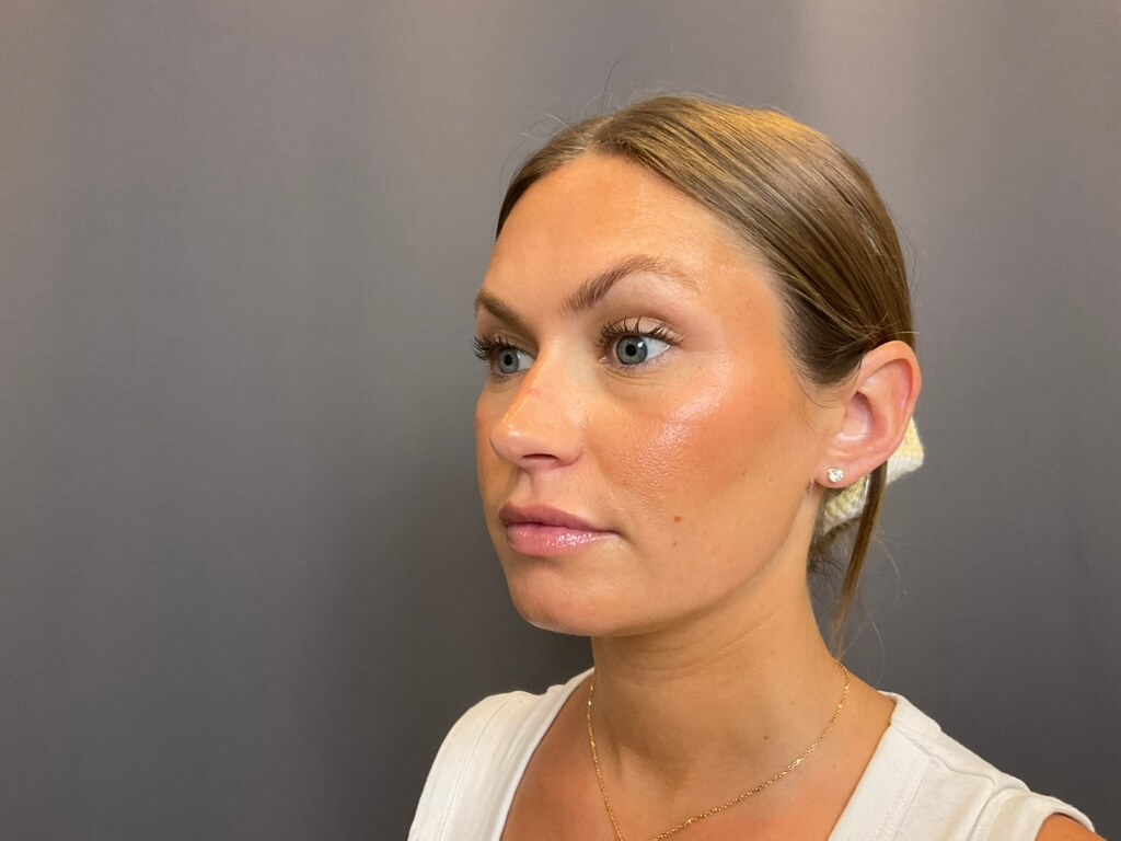Lip Filler After