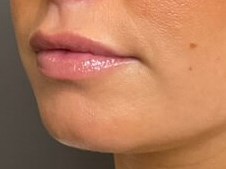 Lip Filler After