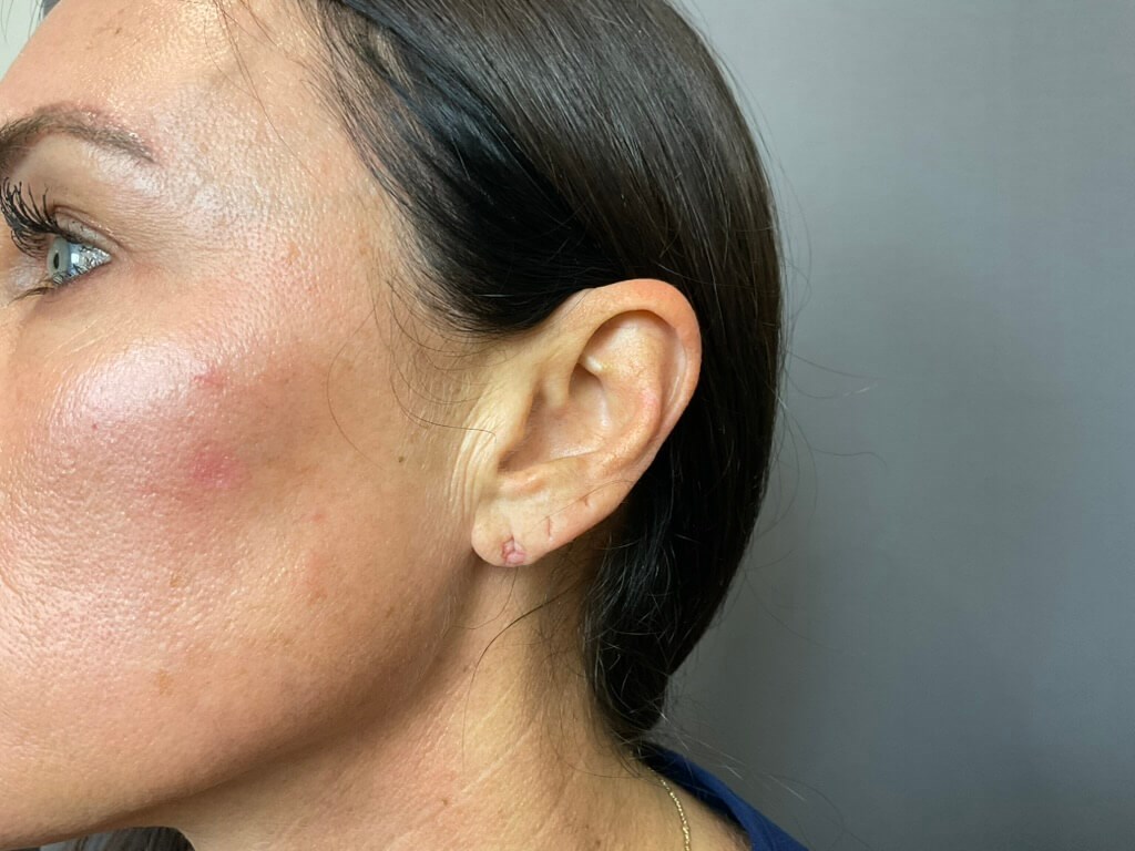 Earlobe Filler Before