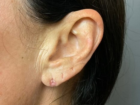 Earlobe Filler Before
