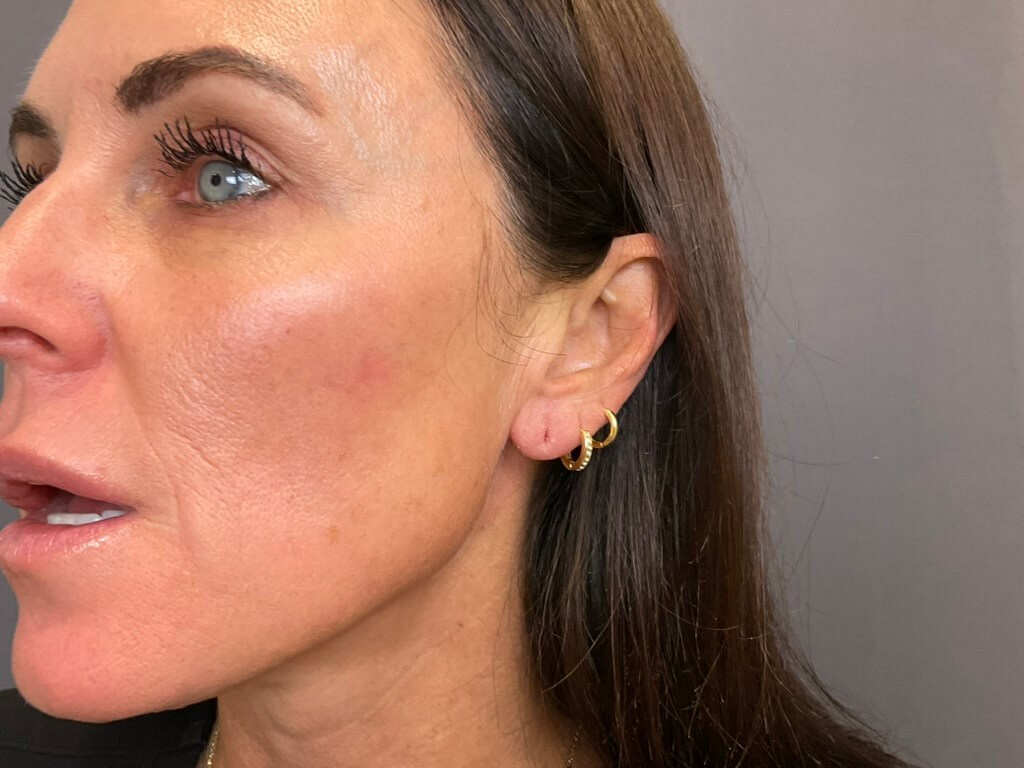 Earlobe Filler After